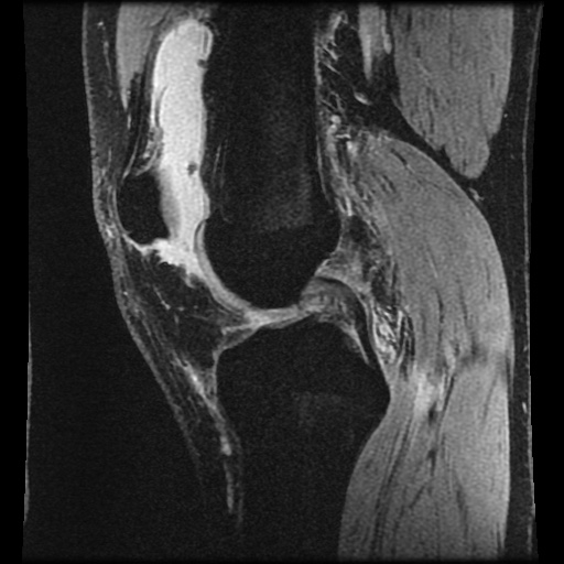 Anterior cruciate ligament tear (Radiopaedia 61500-69462 F 38).jpg
