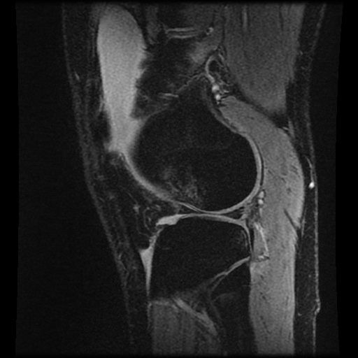 Anterior cruciate ligament tear (Radiopaedia 61500-69462 F 72).jpg