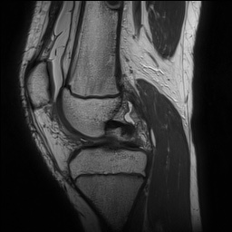 File:Anterior cruciate ligament tear - pediatric (Radiopaedia 62152-70260 Sagittal PD 74).jpg