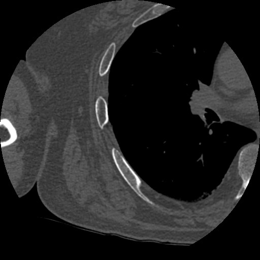 Anterior glenohumeral dislocation with Hill-Sachs lesion (Radiopaedia 62877-71249 Axial bone window 98).jpg