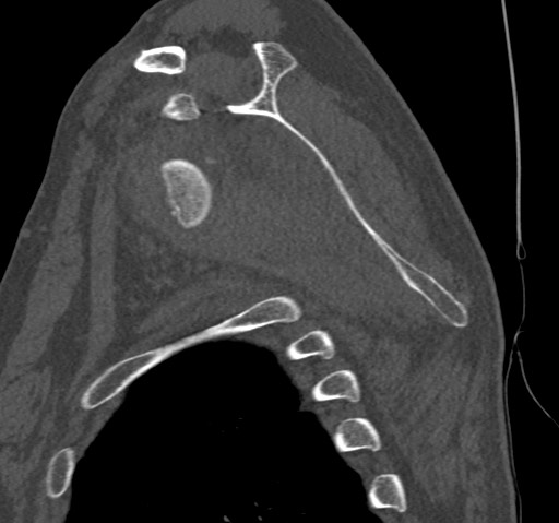 Anterior glenohumeral dislocation with Hill-Sachs lesion (Radiopaedia 62877-71249 Sagittal bone window 41).jpg
