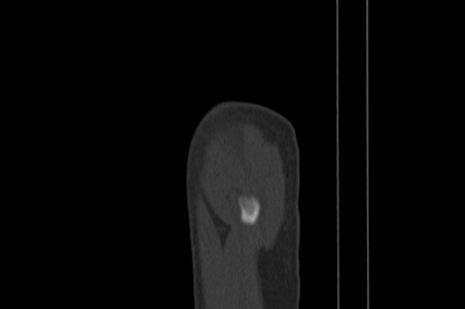 Anterior inferior iliac spine avulsion injury (Radiopaedia 88666-105376 Sagittal bone window 96).jpg