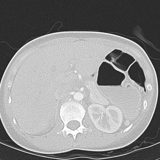 Anterior mediastinal lymphoma (Radiopaedia 29556-30061 Axial lung window 59).jpg