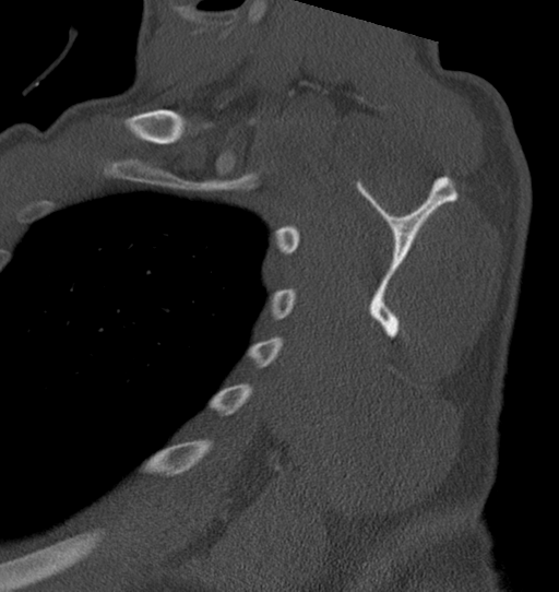 Anterior shoulder dislocation with Hill-Sachs and bony Bankart lesions (Radiopaedia 40424-42974 Sagittal bone window 37).png