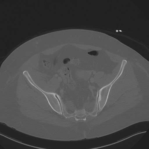Anterior superior iliac spine avulsion fracture (Radiopaedia 44541-48244 Axial bone window 80).png