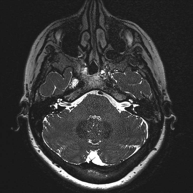 Anterior temporal encephalocele (Radiopaedia 82624-96808 Axial T2 high res 14).jpg