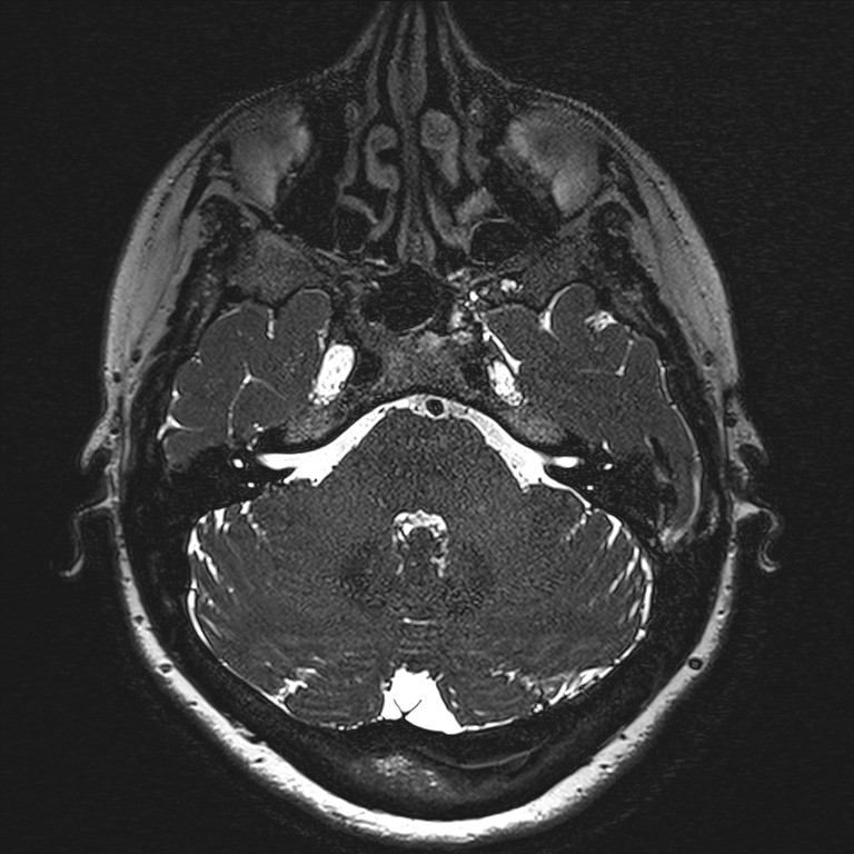Anterior temporal encephalocele (Radiopaedia 82624-96808 Axial T2 high res 23).jpg
