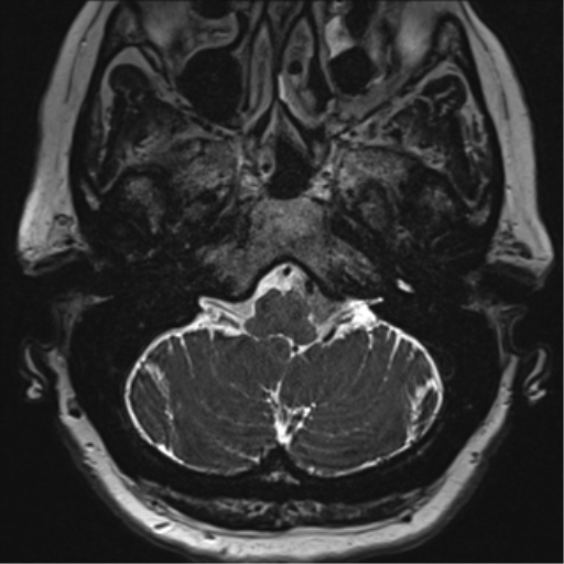 Anterior temporal pole cysts (Radiopaedia 46629-51102 Axial T2 18).png