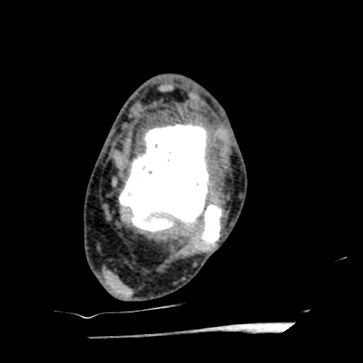 Anterior tibial artery false aneurysm (Radiopaedia 88984-105809 A 143).jpg