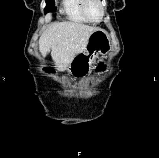 Aortic aneurysm and Lemmel syndrome (Radiopaedia 86499-102554 C 6).jpg