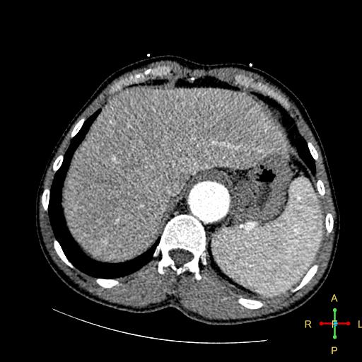 File:Aortic aneurysm and penetrating ulcer (Radiopaedia 23590-23704 A 28).jpg