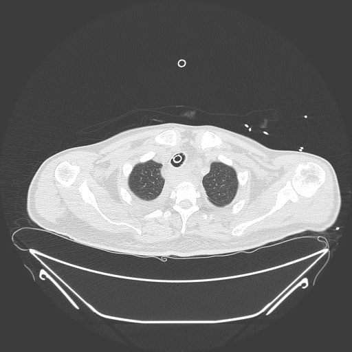 Aortic arch aneurysm (Radiopaedia 84109-99365 Axial lung window 55).jpg