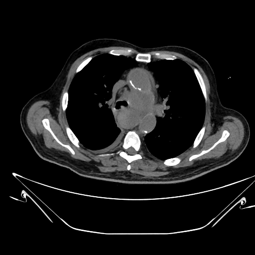 Aortic arch aneurysm (Radiopaedia 84109-99365 Axial non-contrast 109).jpg