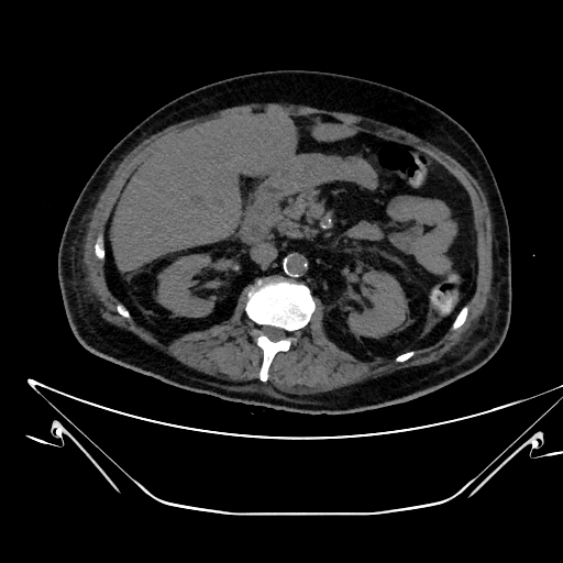 Aortic arch aneurysm (Radiopaedia 84109-99365 Axial non-contrast 326).jpg