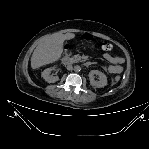 Aortic arch aneurysm (Radiopaedia 84109-99365 Axial non-contrast 344).jpg