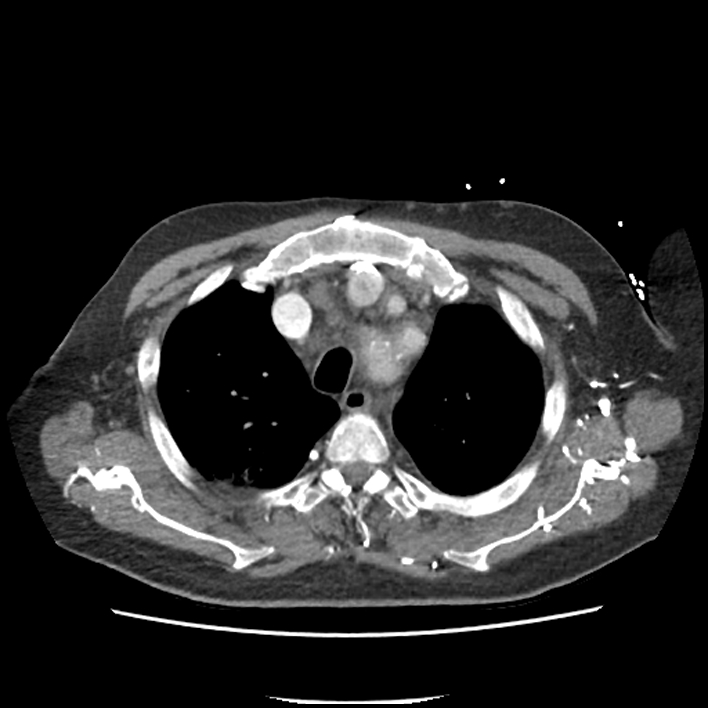Aortic arch graft infection (FDG PET-CT) (Radiopaedia 71975-82437 A 10).jpg