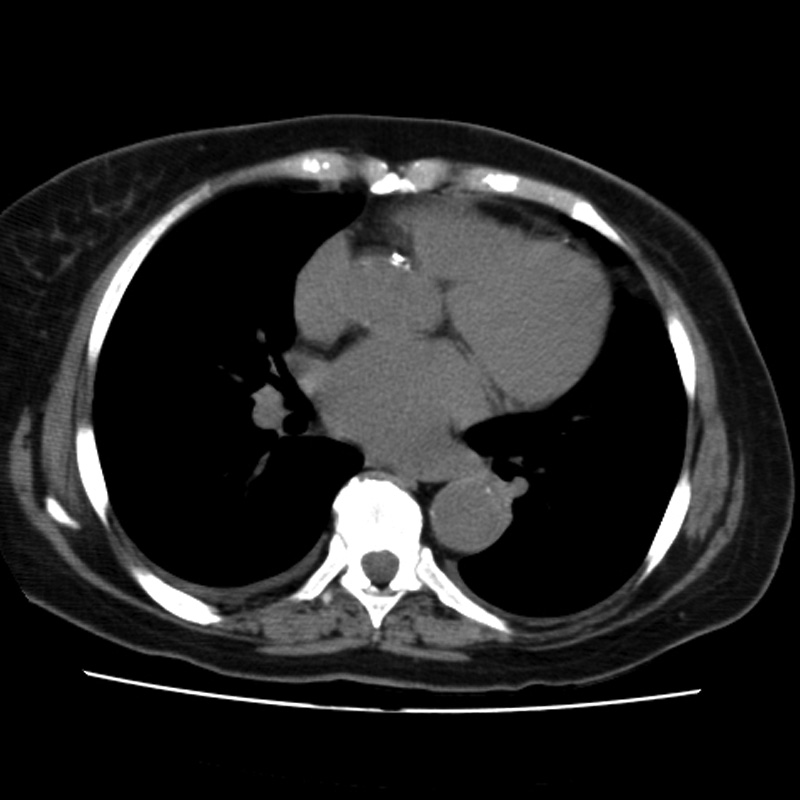 Aortic arch pseudoaneurysm (Radiopaedia 8534-9368 Axial non-contrast 44).jpg