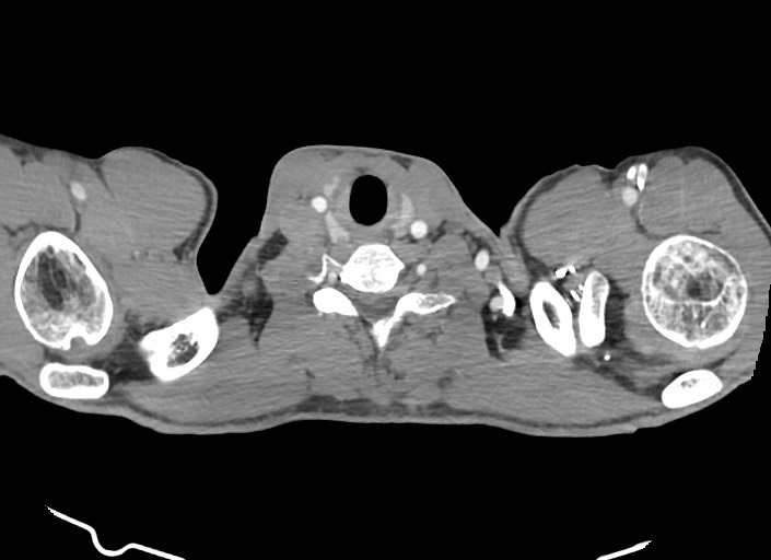 File:Aortic coarctation with aneurysm (Radiopaedia 74818-85828 A 193).jpg