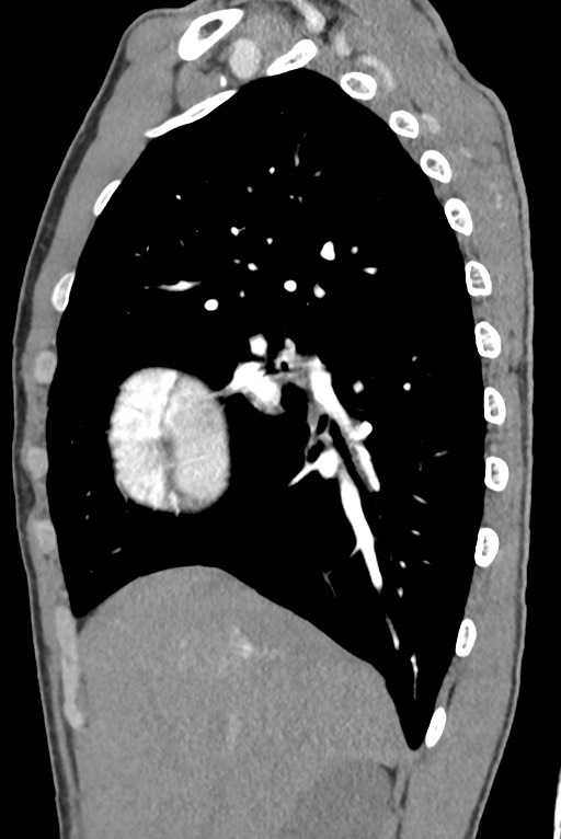 Aortic coarctation with aneurysm (Radiopaedia 74818-85828 B 51).jpg