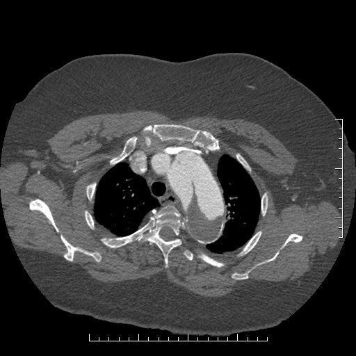Aortic dissection- Stanford A (Radiopaedia 35729-37268 A 13).jpg