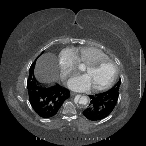 File:Aortic dissection- Stanford A (Radiopaedia 35729-37268 A 67).jpg