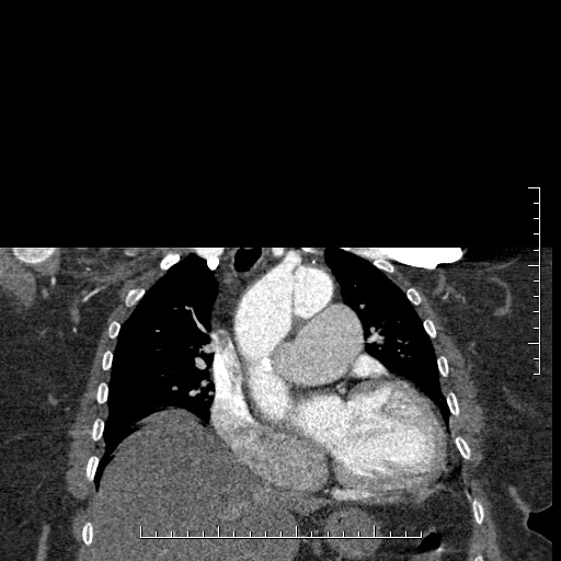 File:Aortic dissection- Stanford A (Radiopaedia 35729-37268 E 37).jpg