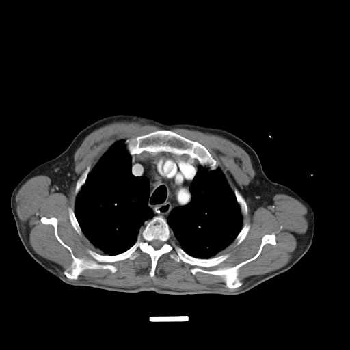 Aortic dissection- Stanford type A (Radiopaedia 22085-22085 A 12).jpg