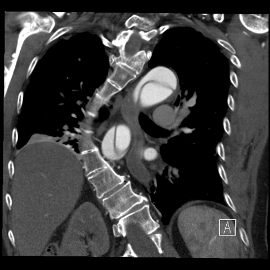 Aortic dissection (CTPA) (Radiopaedia 75506-86750 B 49).jpg