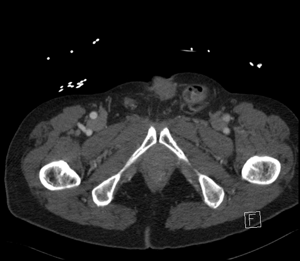 Aortic dissection (CTPA) (Radiopaedia 75506-86750 E 160).jpg