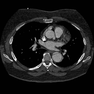 File:Aortic dissection (Radiopaedia 57969-64959 A 160).jpg