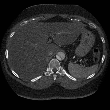 File:Aortic dissection (Radiopaedia 57969-64959 A 299).jpg