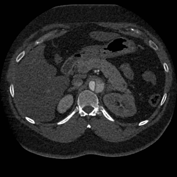 Aortic dissection (Radiopaedia 57969-64959 A 344).jpg