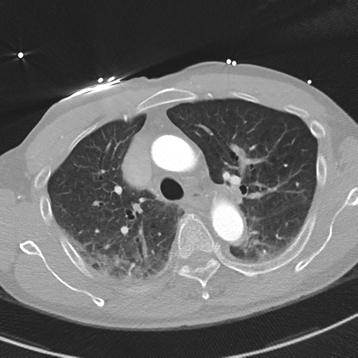 File:Aortic dissection - DeBakey type II (Radiopaedia 64302-73082 Axial lung window 20).png