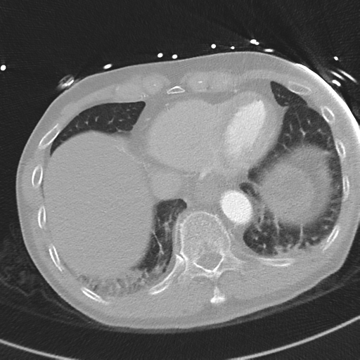 Aortic dissection - DeBakey type II (Radiopaedia 64302-73082 Axial lung window 51).png
