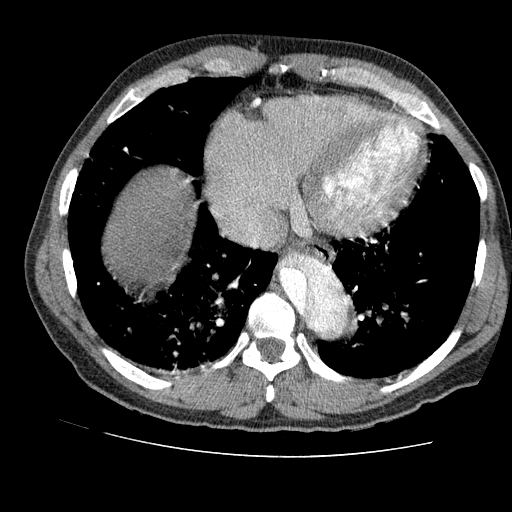 File:Aortic dissection - Stanford A -DeBakey I (Radiopaedia 28339-28587 B 74).jpg