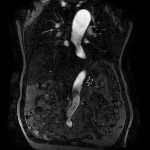 Aortic dissection - Stanford A - DeBakey I (Radiopaedia 23469-23551 D 125).jpg