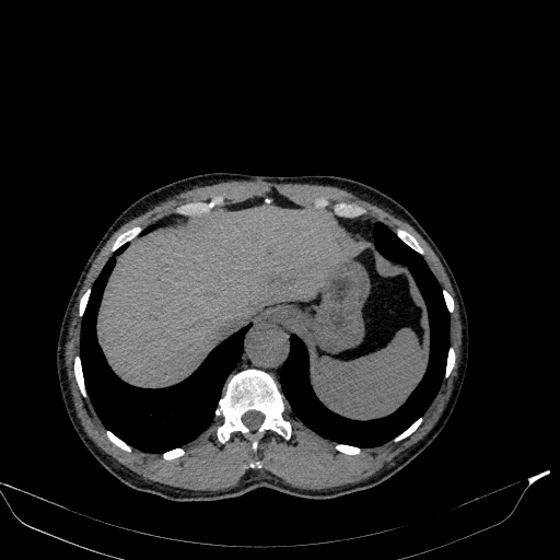 Aortic dissection - Stanford type A (Radiopaedia 83418-98500 Axial non-contrast 39).jpg