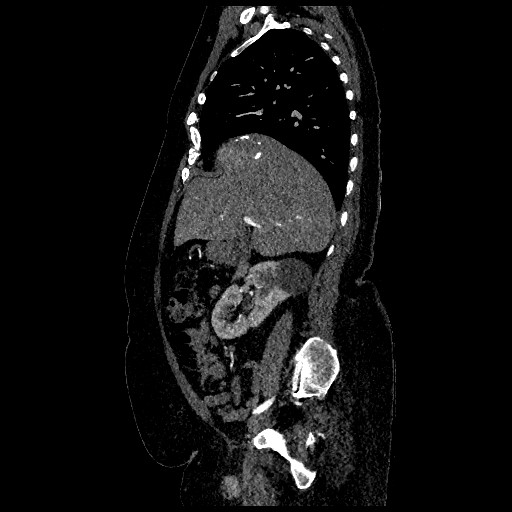 Aortic dissection - Stanford type B (Radiopaedia 88281-104910 C 24).jpg