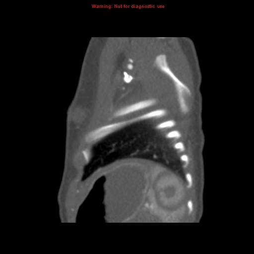 File:Aortic ductus diverticulum (Radiopaedia 8339-9180 C 72).jpg