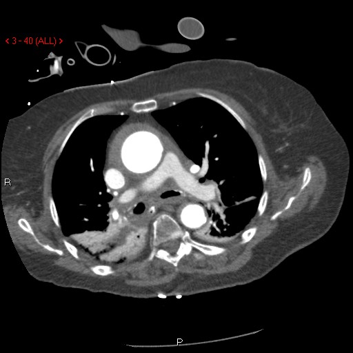 Aortic intramural hematoma (Radiopaedia 27746-28001 A 40).jpg