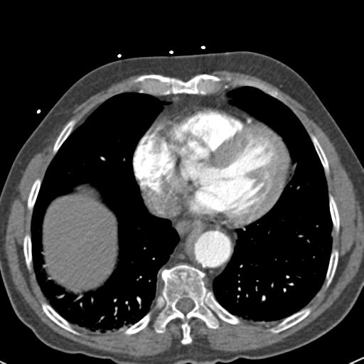 Aortic intramural hematoma (Radiopaedia 31139-31838 B 61).jpg