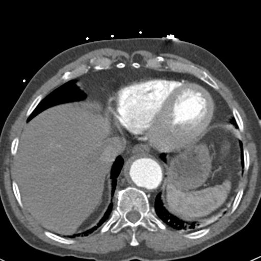 File:Aortic intramural hematoma (Radiopaedia 31139-31838 B 70).jpg