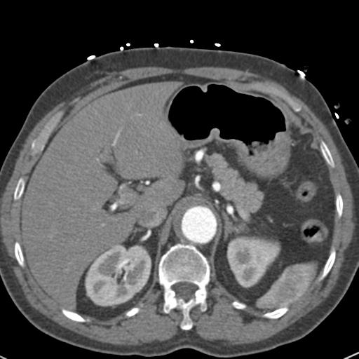 Aortic intramural hematoma (Radiopaedia 31139-31838 B 86).jpg