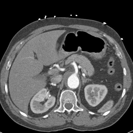 Aortic intramural hematoma (Radiopaedia 31139-31838 B 89).jpg