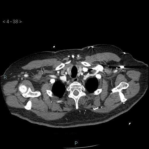 File:Aortic intramural hematoma (Radiopaedia 48463-53380 B 18).jpg