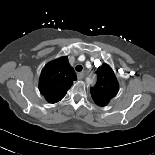 Aortic intramural hematoma from penetrating atherosclerotic ulcer (Radiopaedia 31137-31836 A 13).jpg