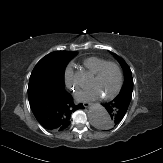 Aortic intramural hematoma with dissection and intramural blood pool (Radiopaedia 77373-89491 Axial non-contrast 60).jpg