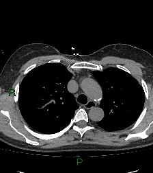 Aortic valve endocarditis (Radiopaedia 87209-103485 Axial non-contrast 33).jpg
