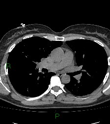 File:Aortic valve endocarditis (Radiopaedia 87209-103485 Axial non-contrast 49).jpg