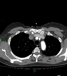 Aortic valve endocarditis (Radiopaedia 87209-103485 C 21).jpg